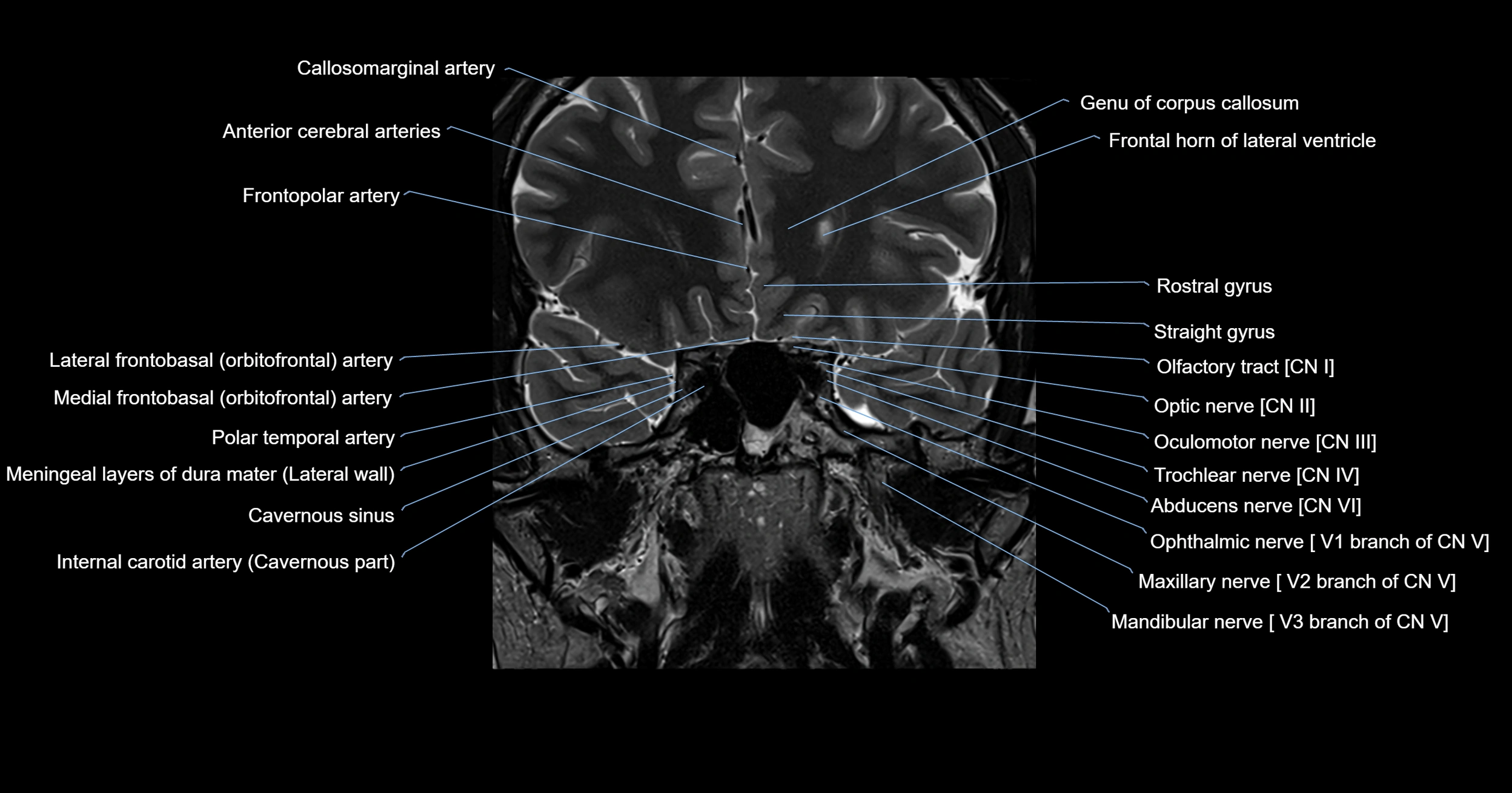 MRI brainstem & basal ganglia anatomy labelled 3T MRI images -img-00001-00005.webp